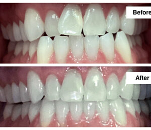 Adult Invisalign Treatment