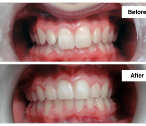 Braces after Deep Bite