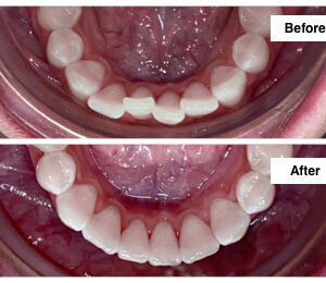 Invisalign Mandibular Anterior Crowding